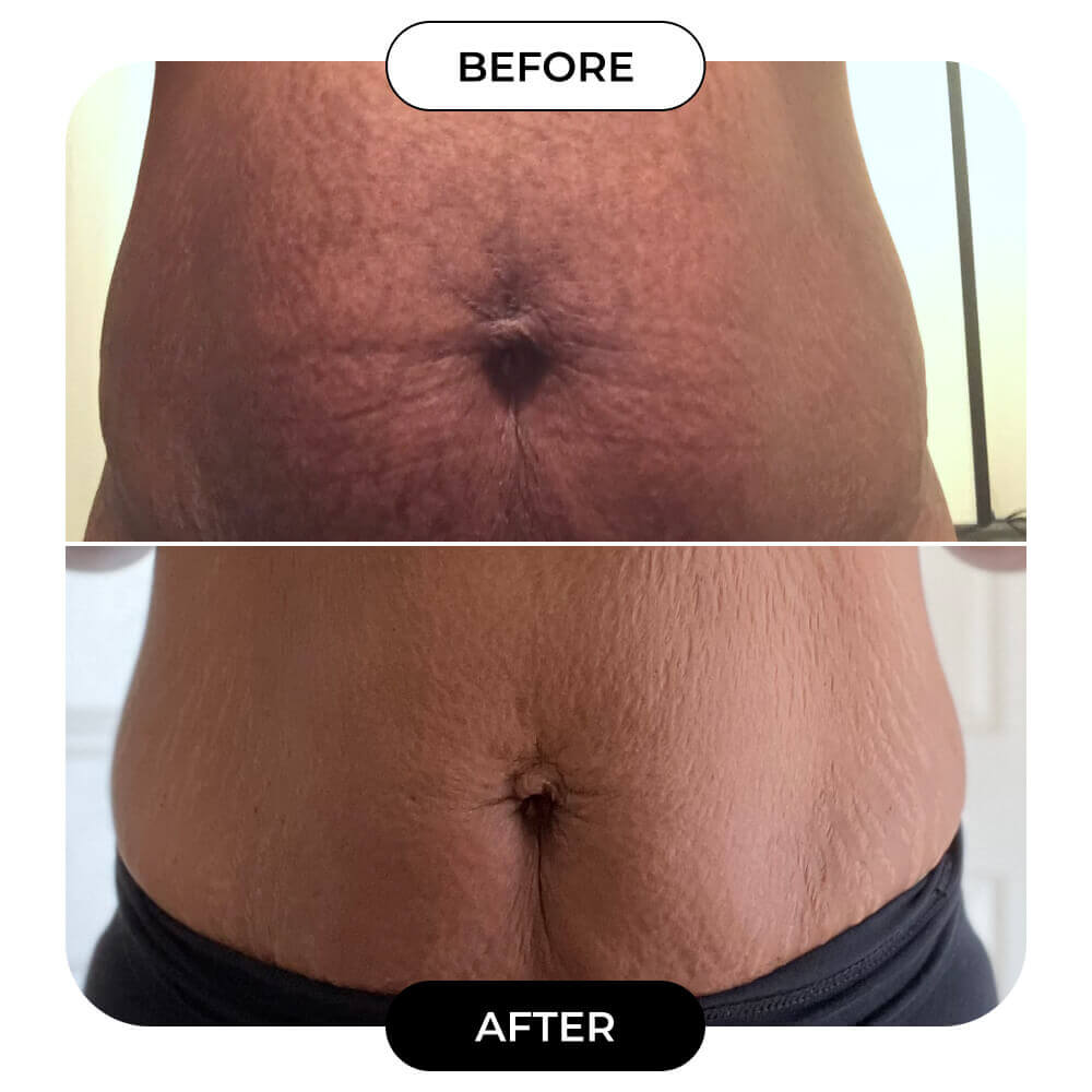 🔥LAST DAY 65% OFF🔥Medazy-B-FLAT Belly Firming Cream