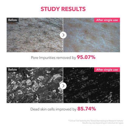 💗 LOVILDS™ 99% High-Purity TXA+Niacinamide Pink Bubble Gum Cleanser for Deep Cleansing, Blackhead Removal & Pore Refinement